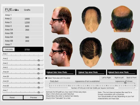 Hair Transplant in Nepal Kathmandu Price List: Why FUEsion Hair Clinics Leads the Way