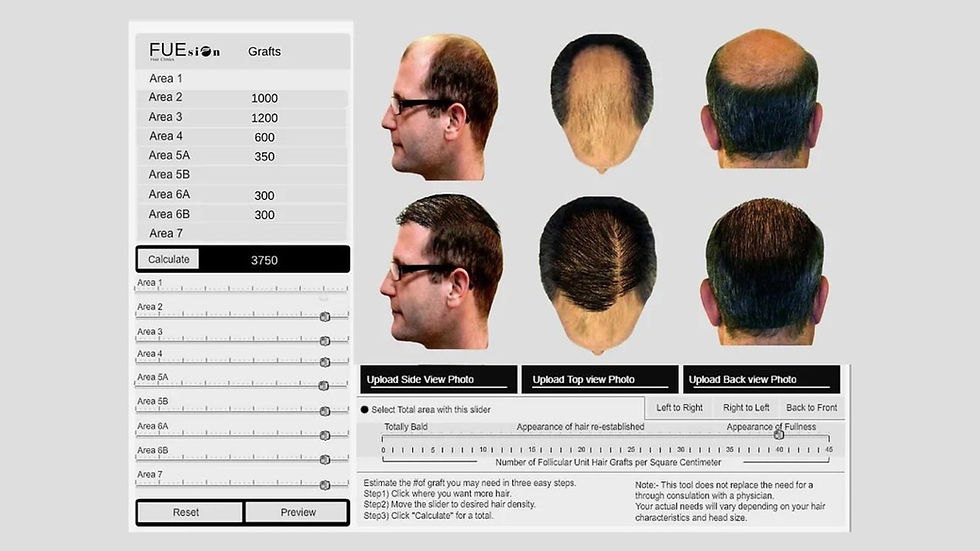 How Much Does Hair Transplant Cost in California: FUEsion Hair Clinics Leading the Way