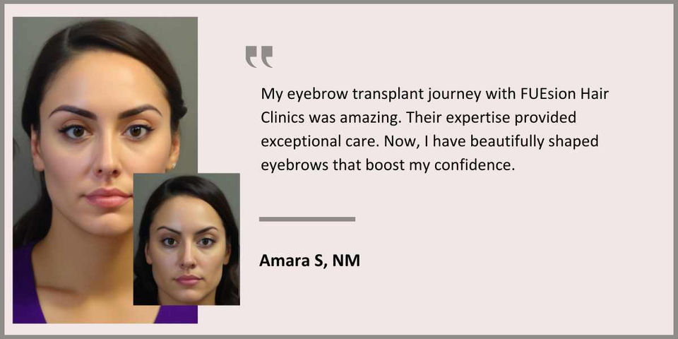 FUEsion Hair Clinics - Eyebrow Transplant Testimonial