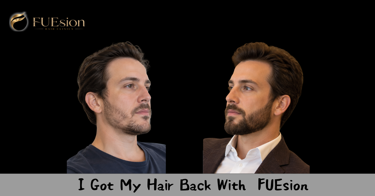 Beard Transplant Before & After — FUEsion Patient