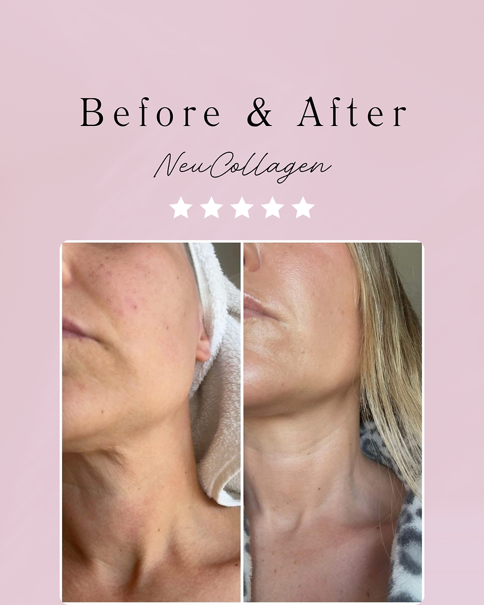 Before and after of neck and jawline showing firmer looking skin and smoother appearance after collagen use in women over 40