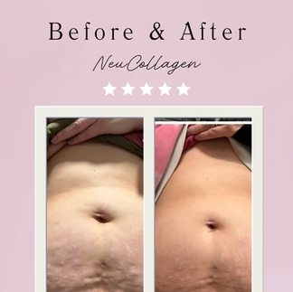 Before and after of abdominal skin showing smoother texture and reduced uneven skin appearance in women over 40 using collagen support