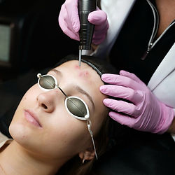 Acne Peel