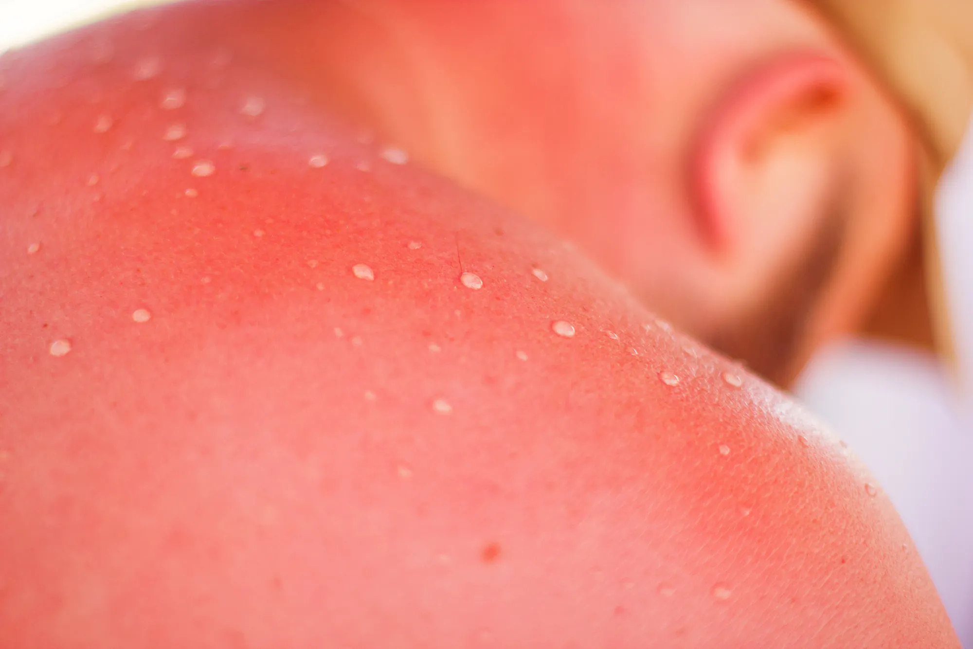 Close-up of man's sunburned chest and shoulders from UV exposure