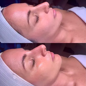 Facial before and after showing glowing skin at Revive Spa—Pinehurst NC facial specialists in skin renewal.