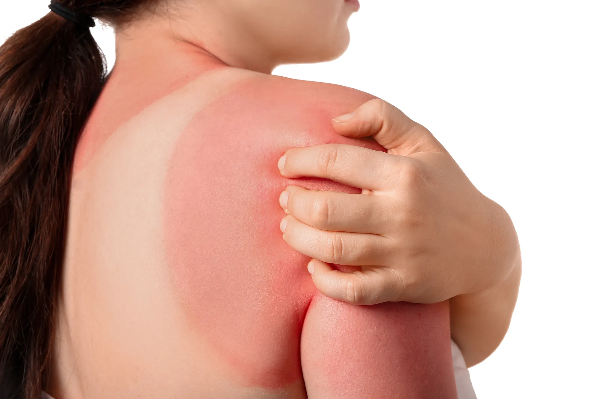Woman with visible sunburn lines on her back from tanning in the sun