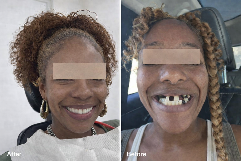Before & After all on 4