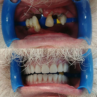 “Before and after All-on-4 full arch restoration following extractions and bone grafting at Baja Dental Smile.”