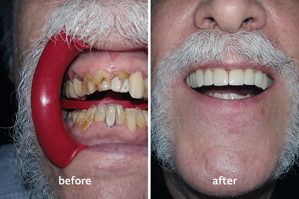 Dental implant transformation before and after