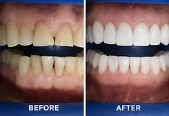 Before & After of a full mouth rehabilitation using Zirconia crowns