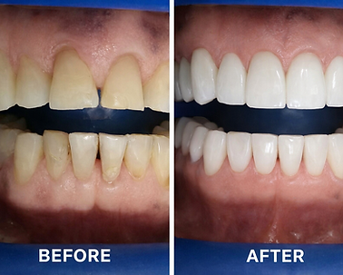 Full mouth rehabilitation at Baja Dental Smile, using Zirconia Crowns