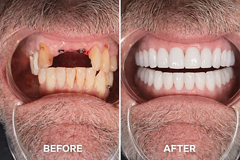 “Before and after full mouth rehabilitation combining dental implants and zirconia crowns for complete smile restoration.”