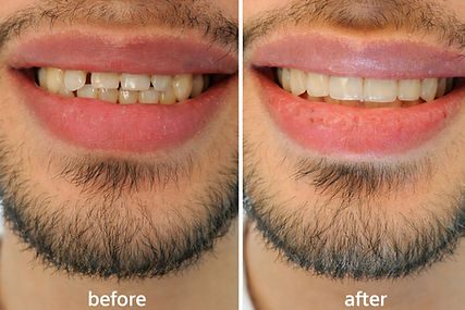 Smile makeover with veneers