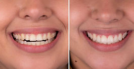 Smile makeovers with Dr Alan Martinez are affordable 