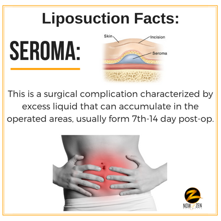 What is a Seroma?