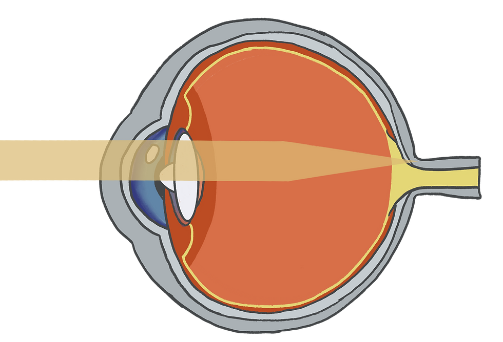hyperopia