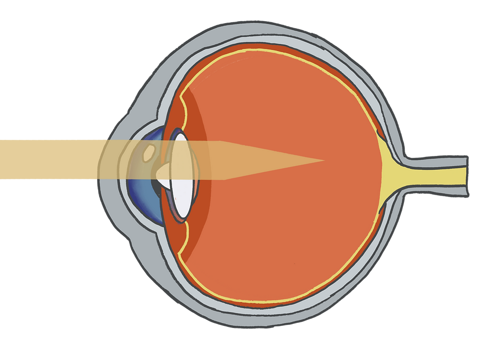 myopia diagram