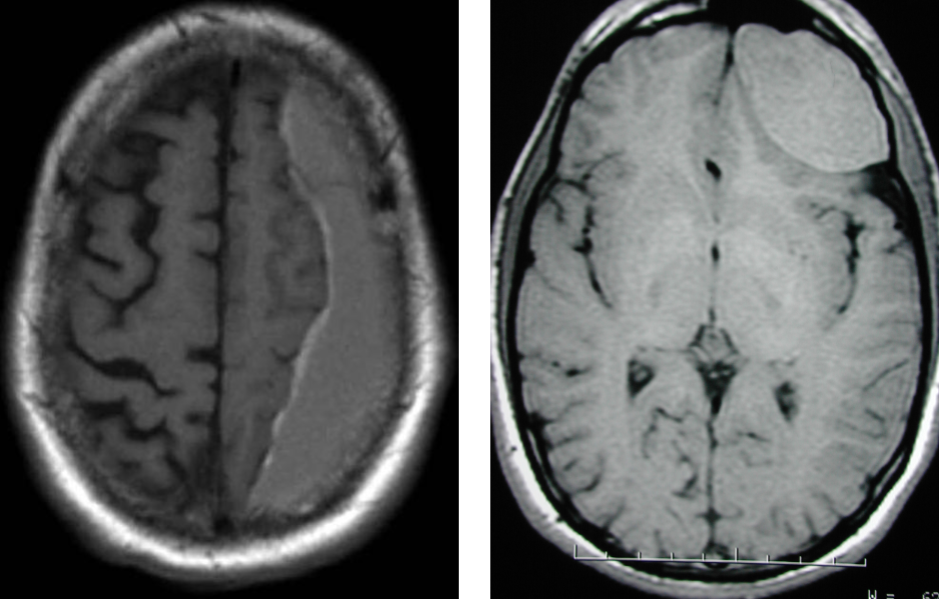 subdural and epidural hematoma on mri