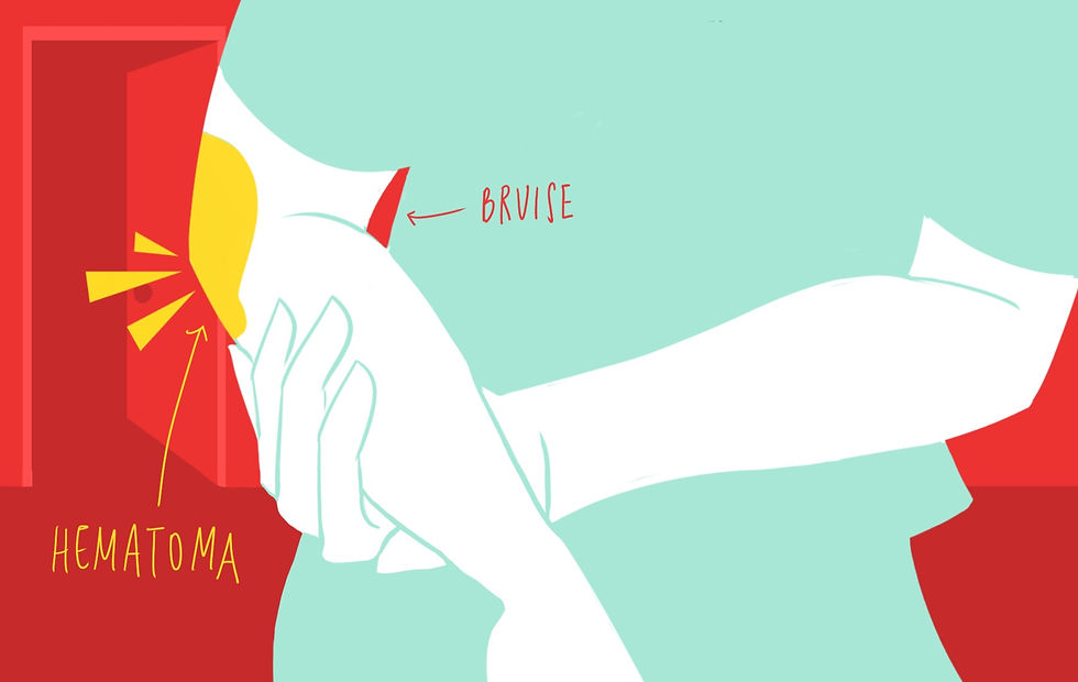hematoma vs bruise diagram