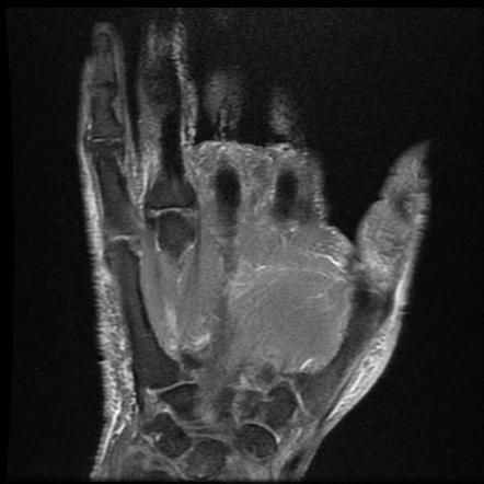 subcutaneous hematoma on hand, mri, skeleton