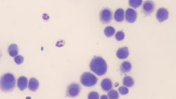 中皮腫　胸腔内液体貯留