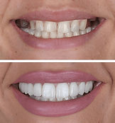 aesthetic-smile-design-treatment-dental-600nw-2528216281.jpg