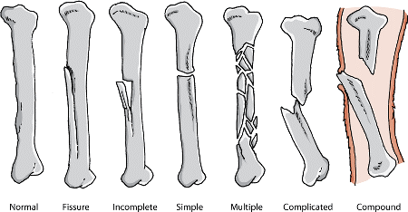 Fractures- Repair options