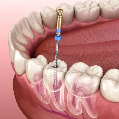 RCT Procedure