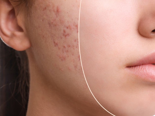 adolescente-acné-extracción-facial-antes-después-si-glam-glow-studio_edited.jpg