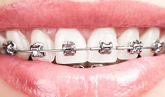 brackets-autoligado-damon-1-e1500298503967.jpg