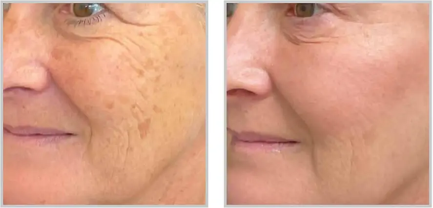before and after 2 months after 1 halo and BBL treatment available at the Goddess Clinic, treating sun spots, wrinkle reduction and redness reduction