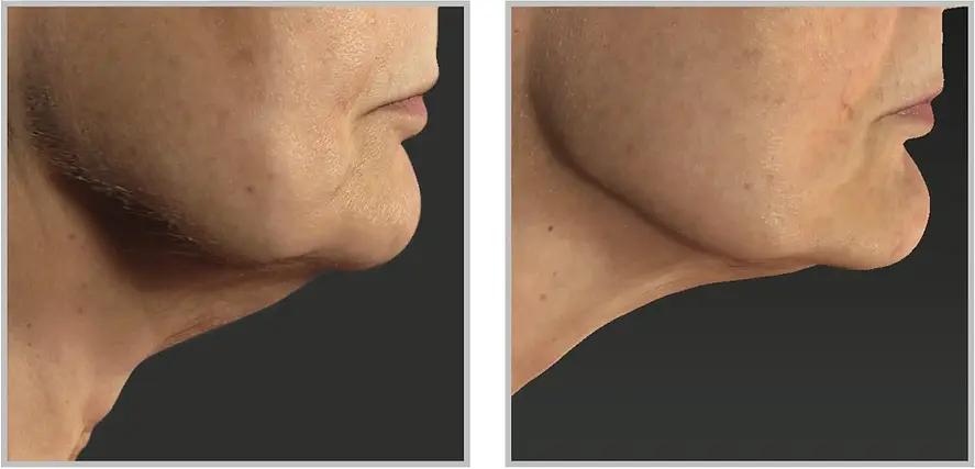 before and after, skintyte treatment for skin laxity available at the goddess clinic edinburgh