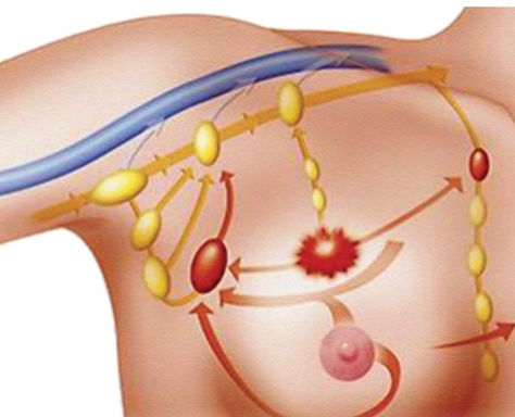 Why is lymphadema so common in breast cancer patients?