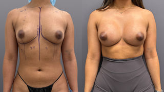 image of a young woman after breast aug surgery with Dr. Mosca - image shows before and after results