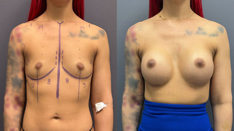 breast-augmentation-nipple-reduction-dr-boca-raton-before-after-front-view.jpg