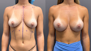Before and after silicone dual plane breast augmentation performed by Dr. Kevin Mosca in Boca Raton.