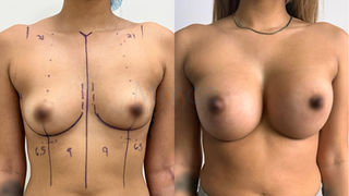 Image - Before and After -Breast Augmentation - Mosca Plastic Surgery