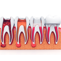 Root Canal Therapy Case Study