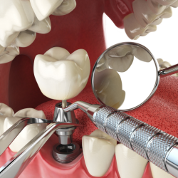 dental implant
