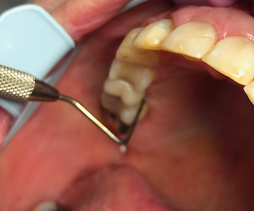 Lommemåling palatinalt.png