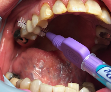 mellomromsbørste lilla palatinalt.png