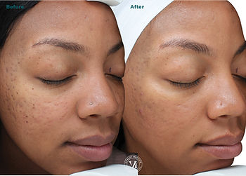 Refresh Your Skin With A Chemical Peel