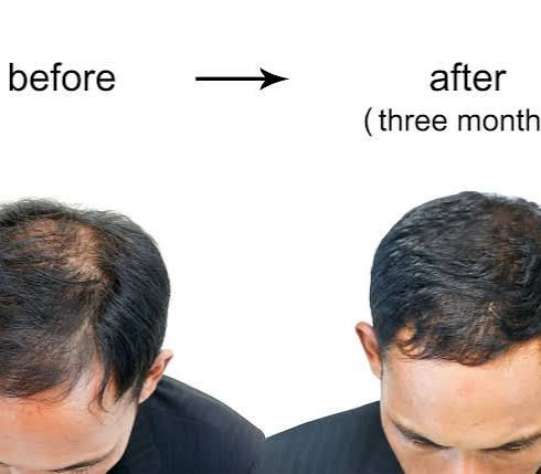 Prp before and after
