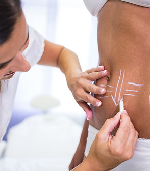 surgeon-drawing-lines-womans-abdomen-liposuction-cellulite-removal.jpg