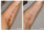 Vi body peel