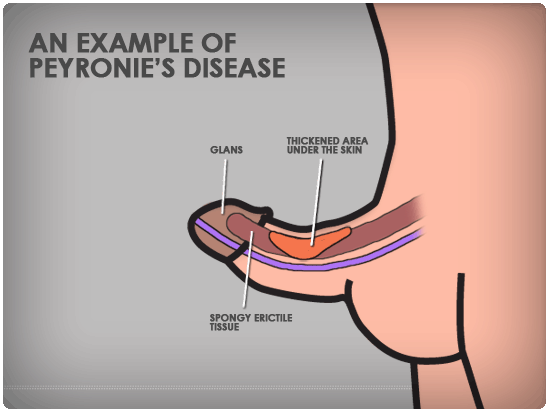 peronies-disease