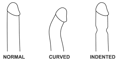 Curved bent penis