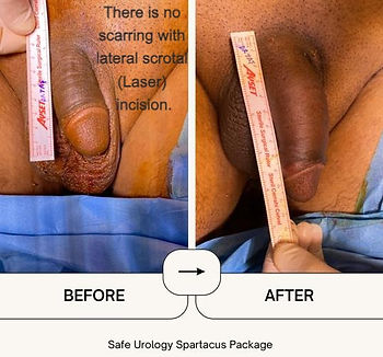 Penis enlargement surgery
