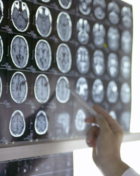 Medical Marijuana and Seizures & Epilepsy