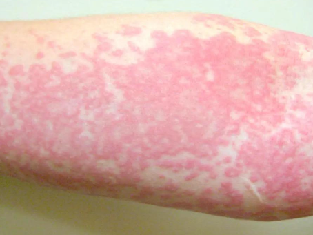Water Pollution and Skin Diseases